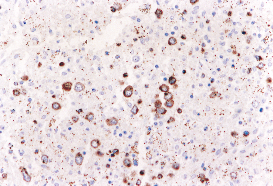 肝脾γ/δT細胞リンパ腫