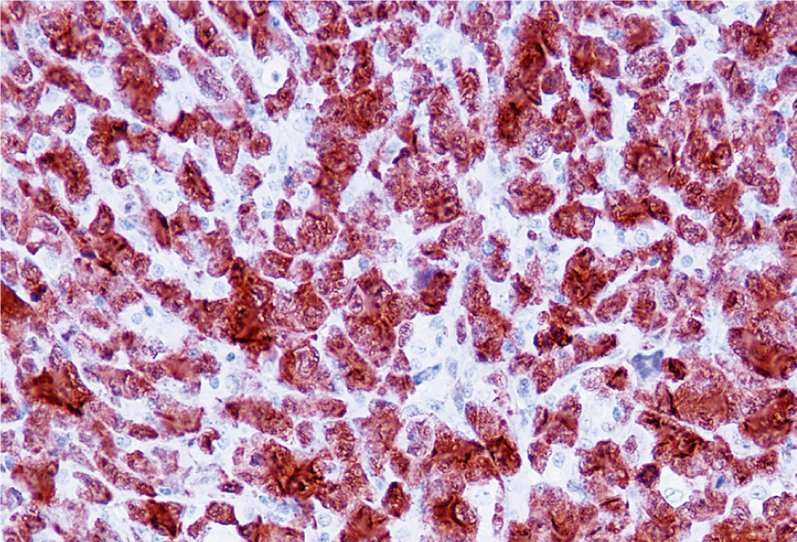 未分化大細胞リンパ腫