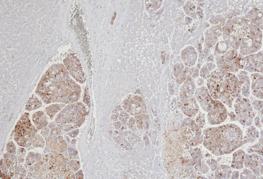 肝細胞癌（抗グリピカン3モノクローナル抗体）