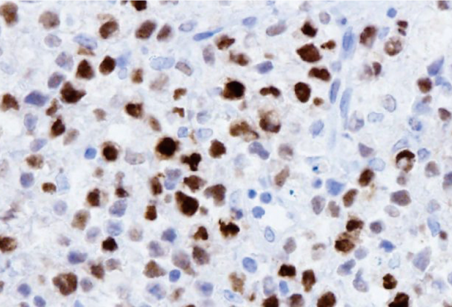 びまん性大細胞リンパ腫
