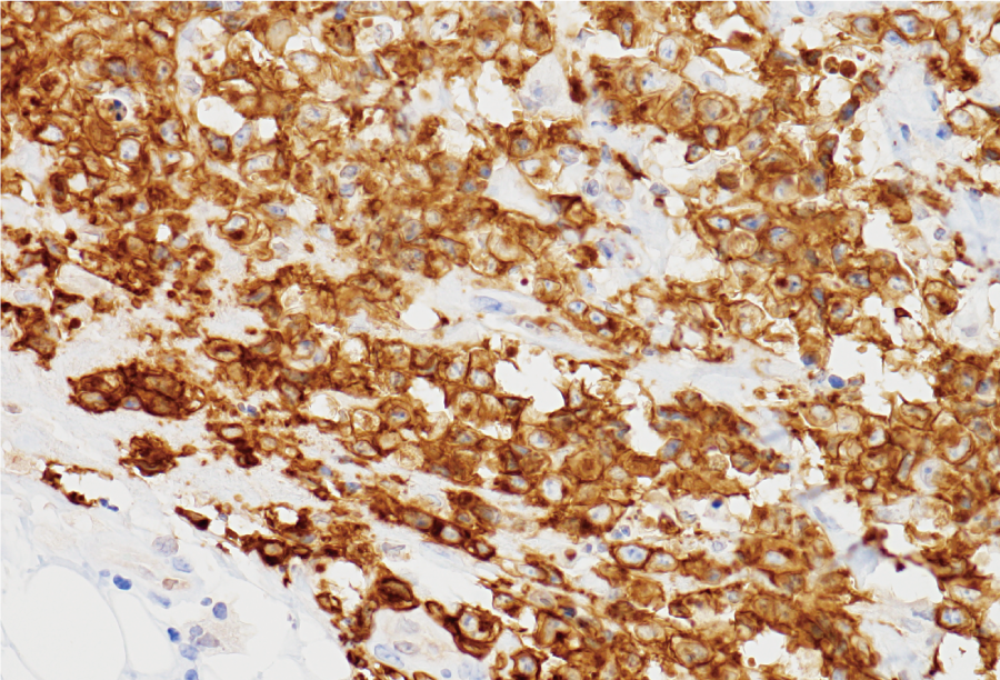未分化大細胞型リンパ腫