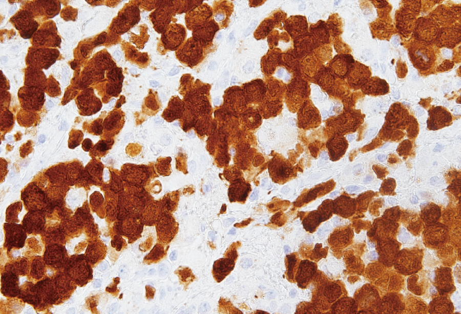 ALK陽性未分化大細胞型リンパ腫