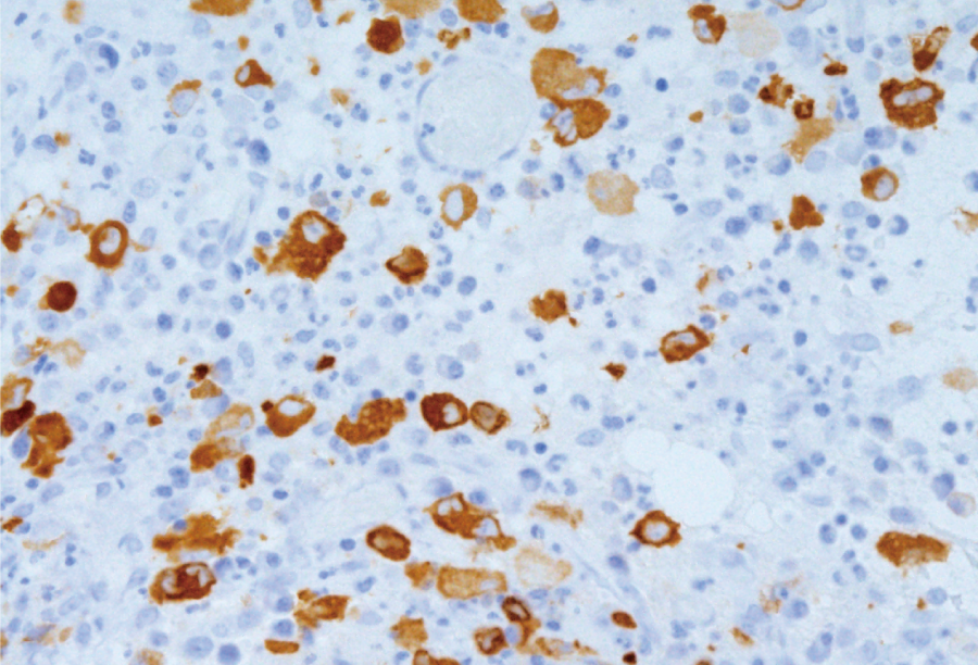 ALK陽性未分化大細胞型リンパ腫