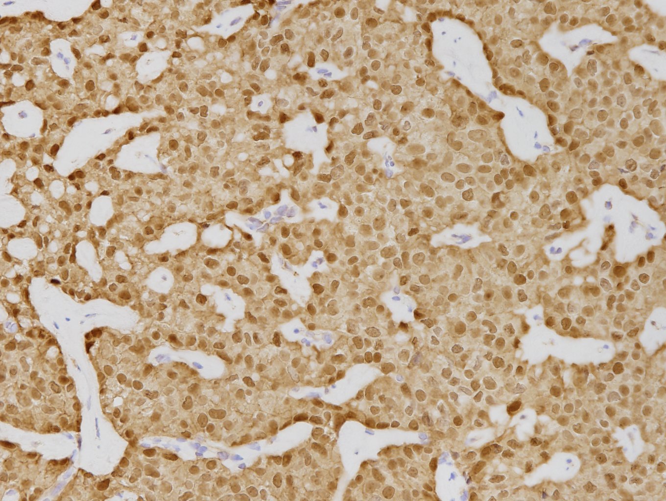 充実性偽乳頭状腫瘍