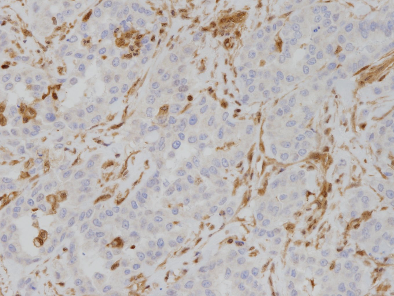 上皮様中皮腫【MTAP loss 例】