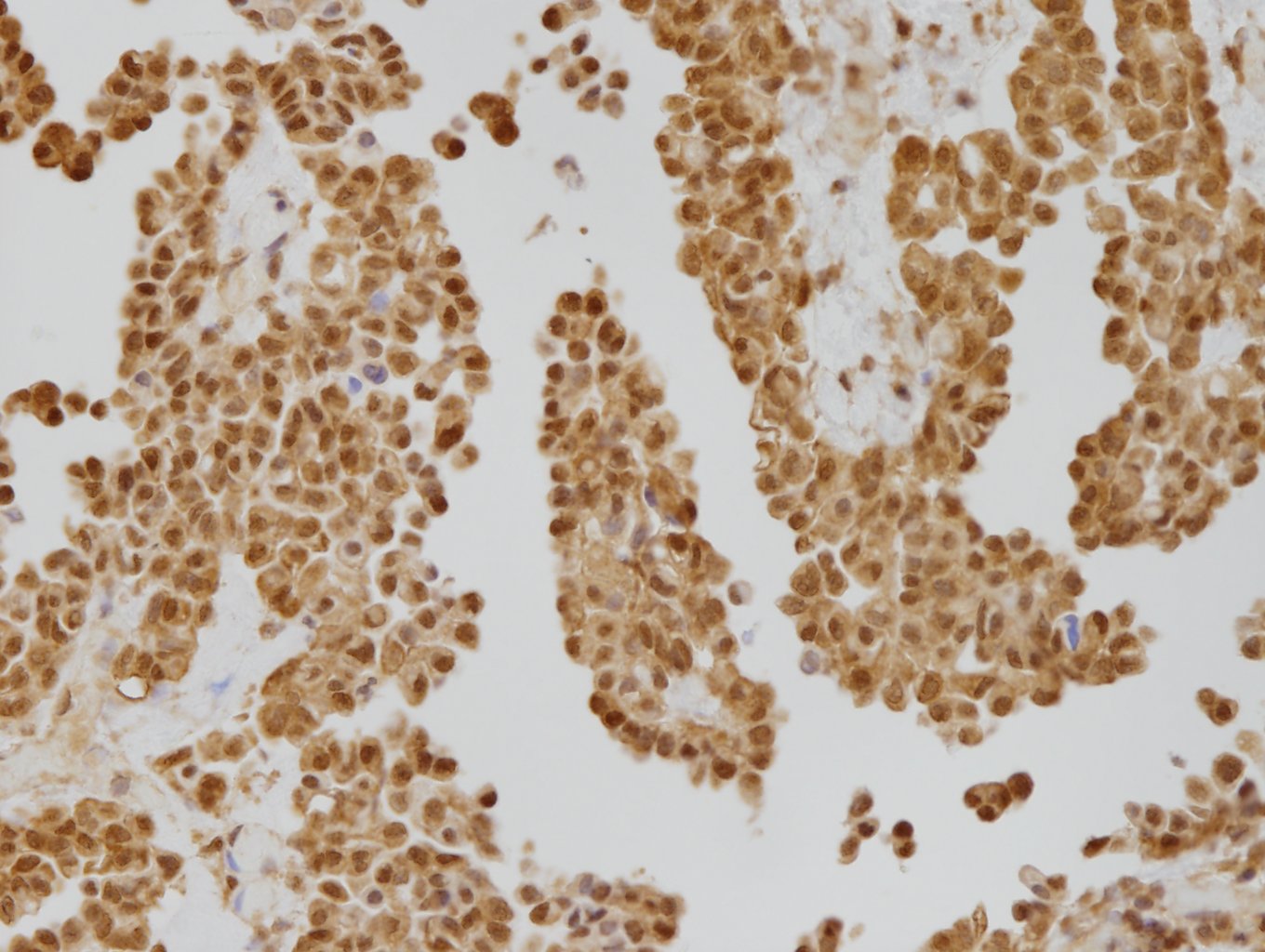 上皮様中皮腫【MTAP 陽性例】