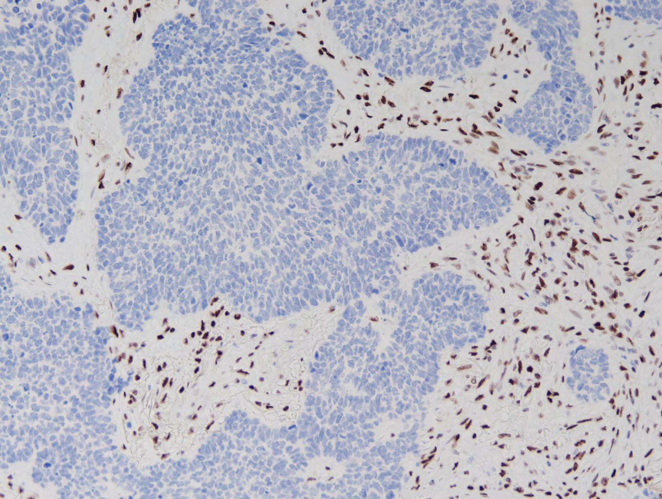 小細胞肺癌（SLFN11陰性例）