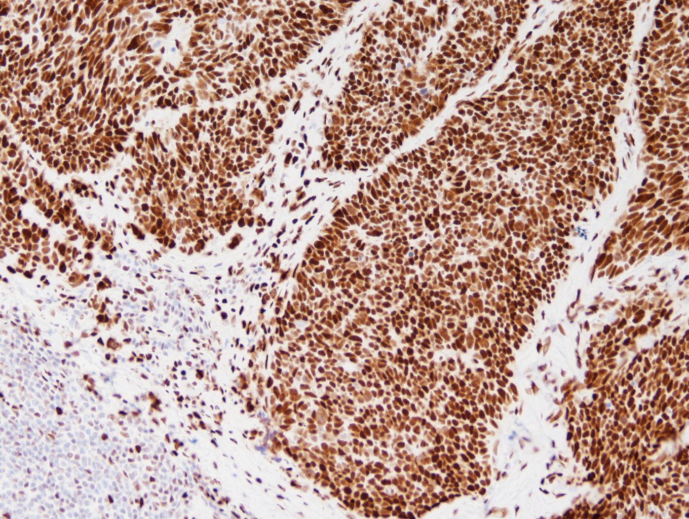 小細胞肺癌（SLFN11陽性例）